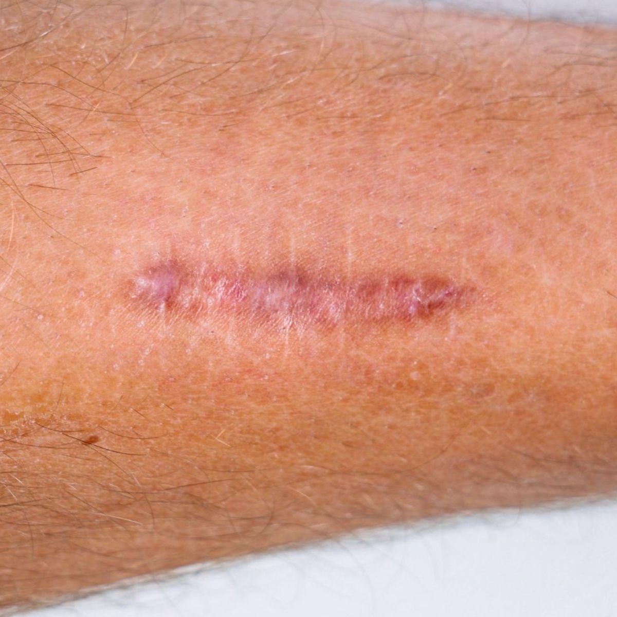 Atténuer les vergetures et cicatrices