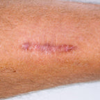 Dermopigmentation cicatrice pour camouflage de cicatrice