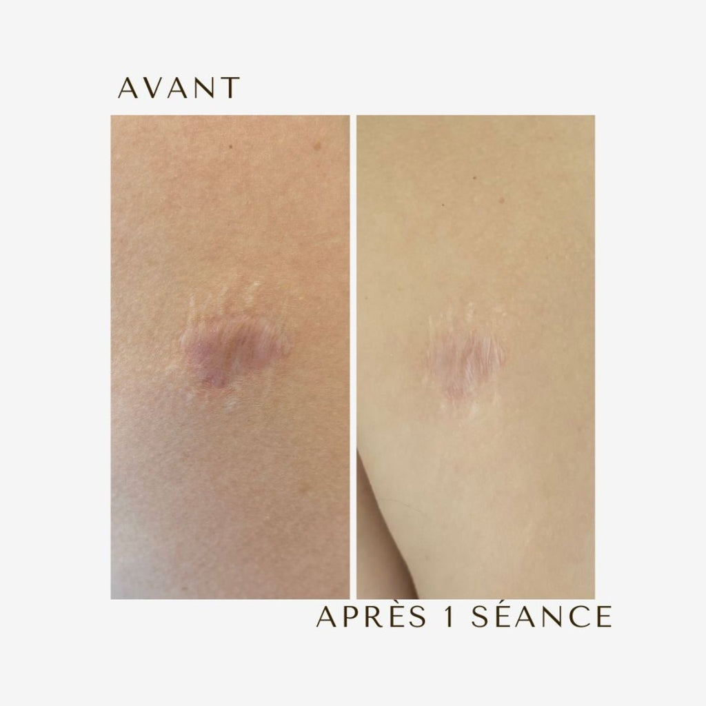 Dermopigmentation cicatrice avant après