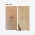 Dermopigmentation cicatrice avant après