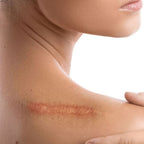 Atténuer cicatrice dermopigmentation