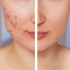 Photobiomodulation acné et imperfections avant après