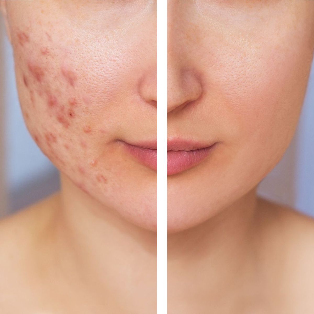 Photobiomodulation acné et imperfections avant après