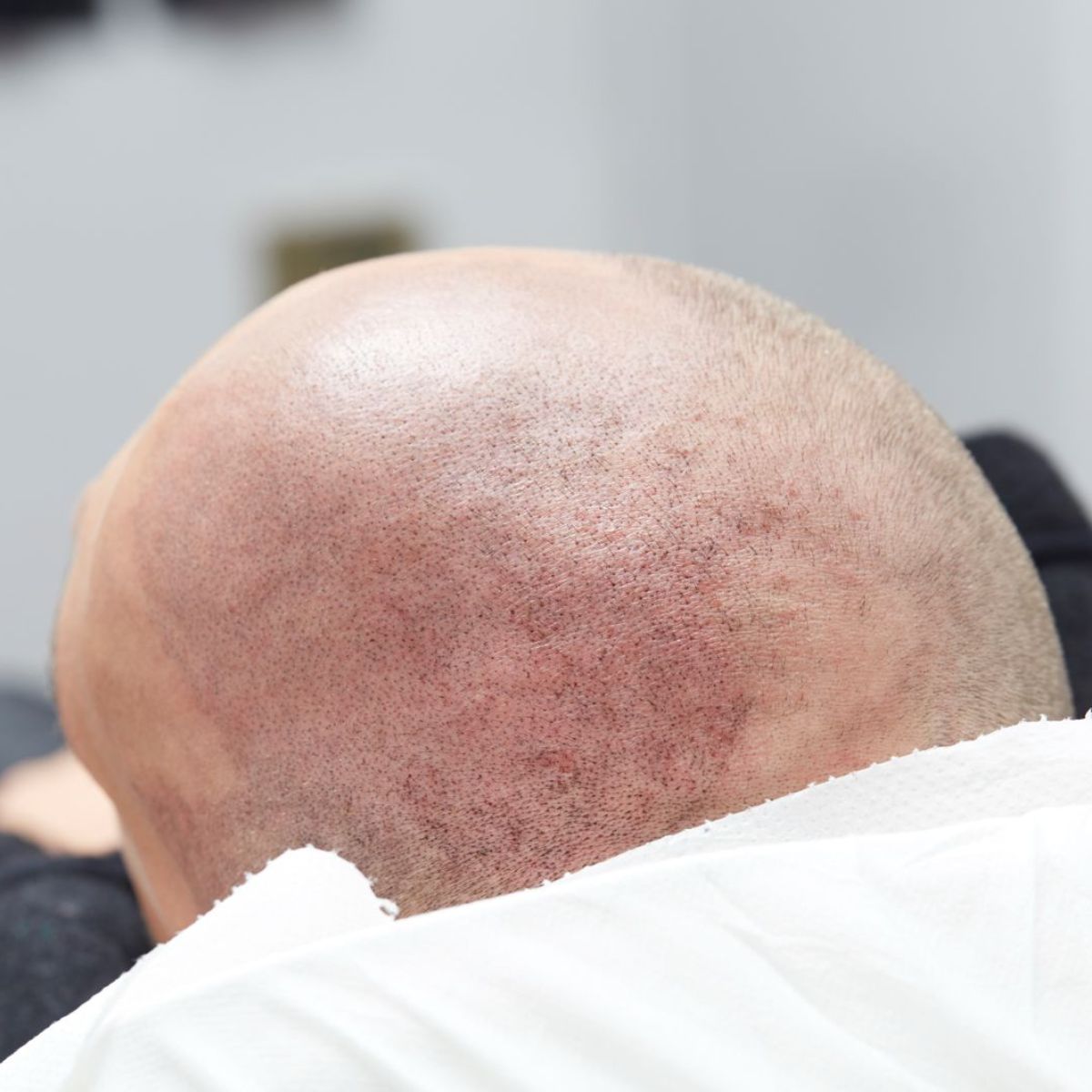 Tricopigmentation cheveux effet crane rasé