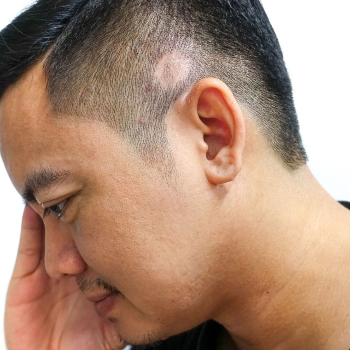 Tricopigmentation camouflage des cicatrices capillaires